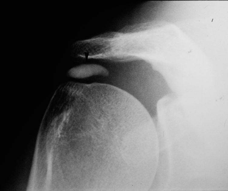 Radiographie épaule calcification
