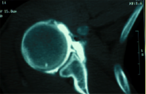 Douleurs épaule arthroscanner